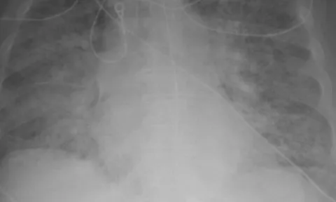 Sự khác biệt của người đã tiêm vắc xin khi nhiễm Covid-19